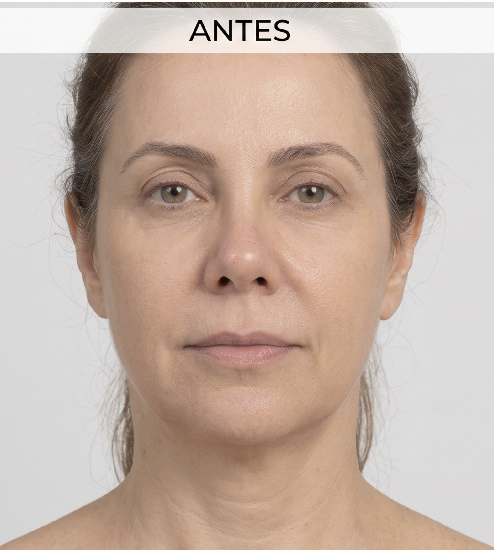 Rinoplastia - Pré