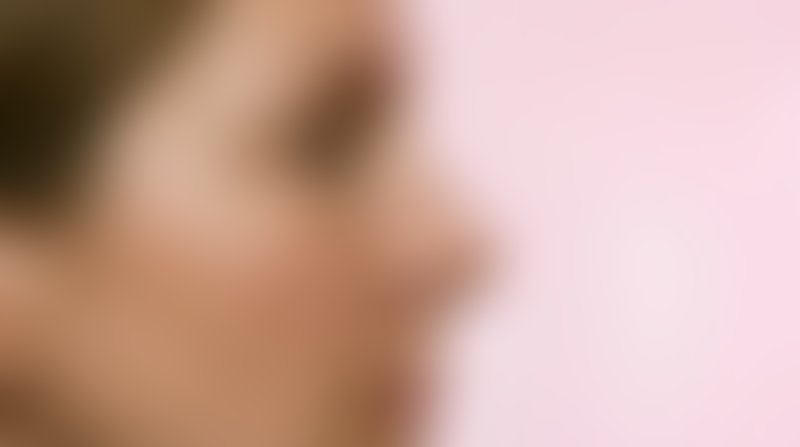 Foto antes de Lifting Facial (Ritidoplastia) realizado por Dr. Jose Fernando