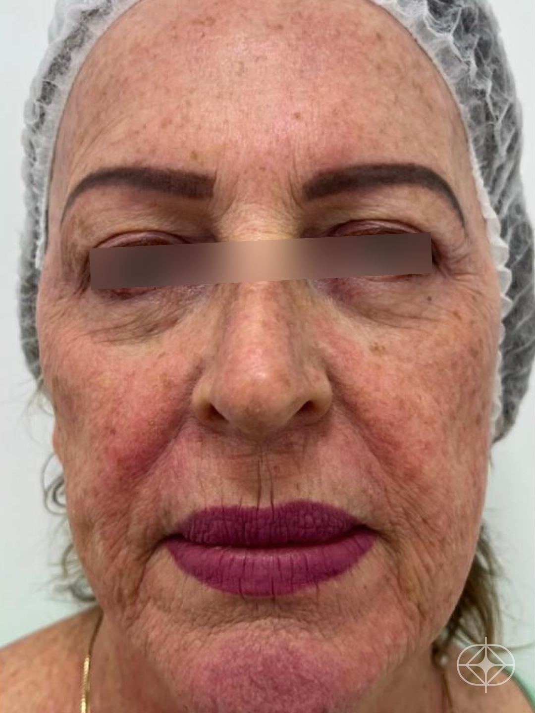 Preenchimento com Ácido Hialurônico - Pré