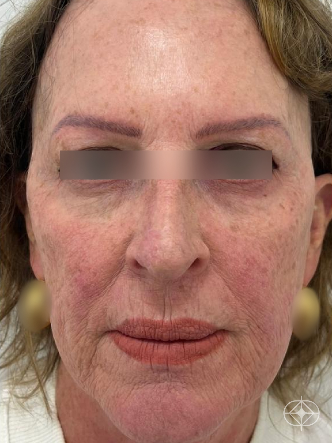 Preenchimento com Ácido Hialurônico - Pós