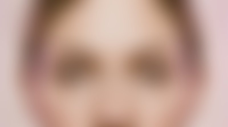 Resultado após Mamoplastia de Aumento realizado por Dr. José Fernando