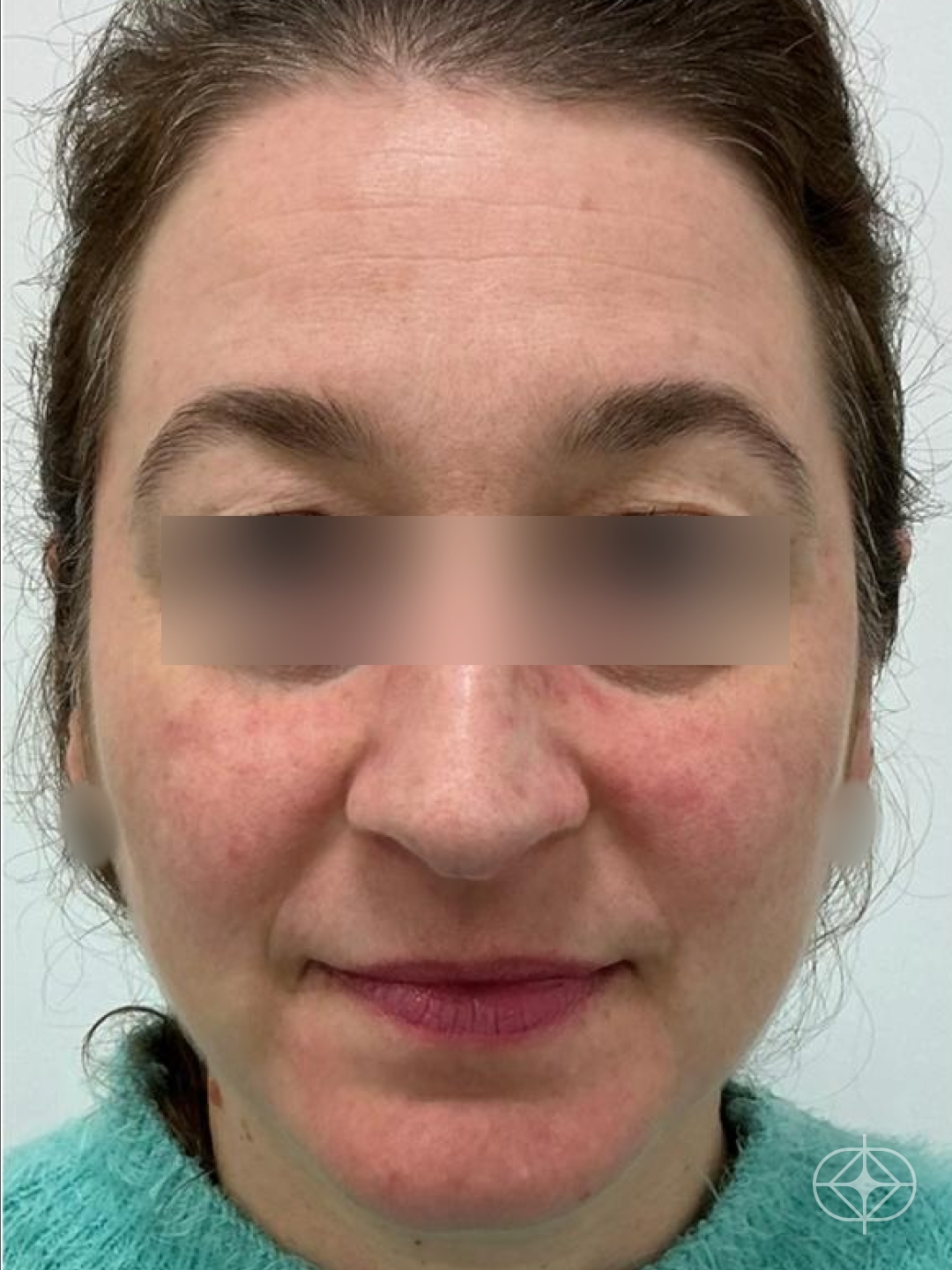 Resultado após Preenchimento com Ácido Hialurônico realizado por Dr. Guilherme Cruz