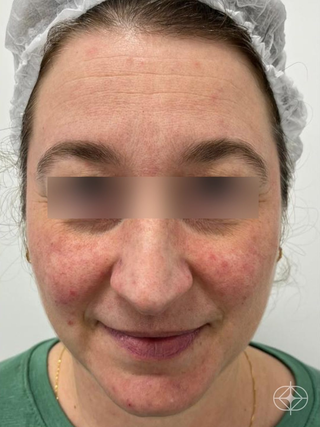 Foto antes de Preenchimento com Ácido Hialurônico realizado por Dr. Guilherme Cruz