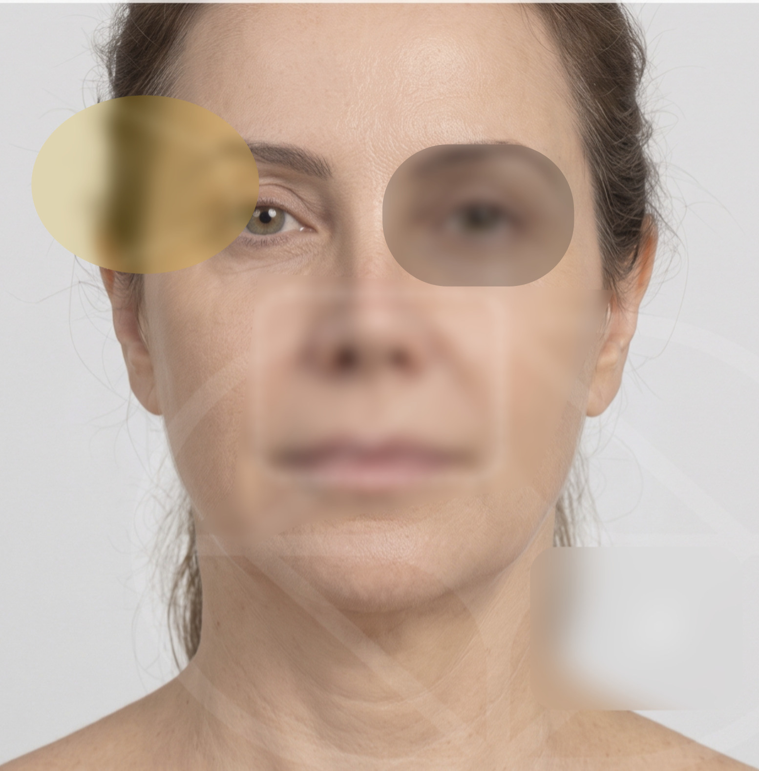 Resultado após Torsoplastia realizado por Dr. Jose Fernando