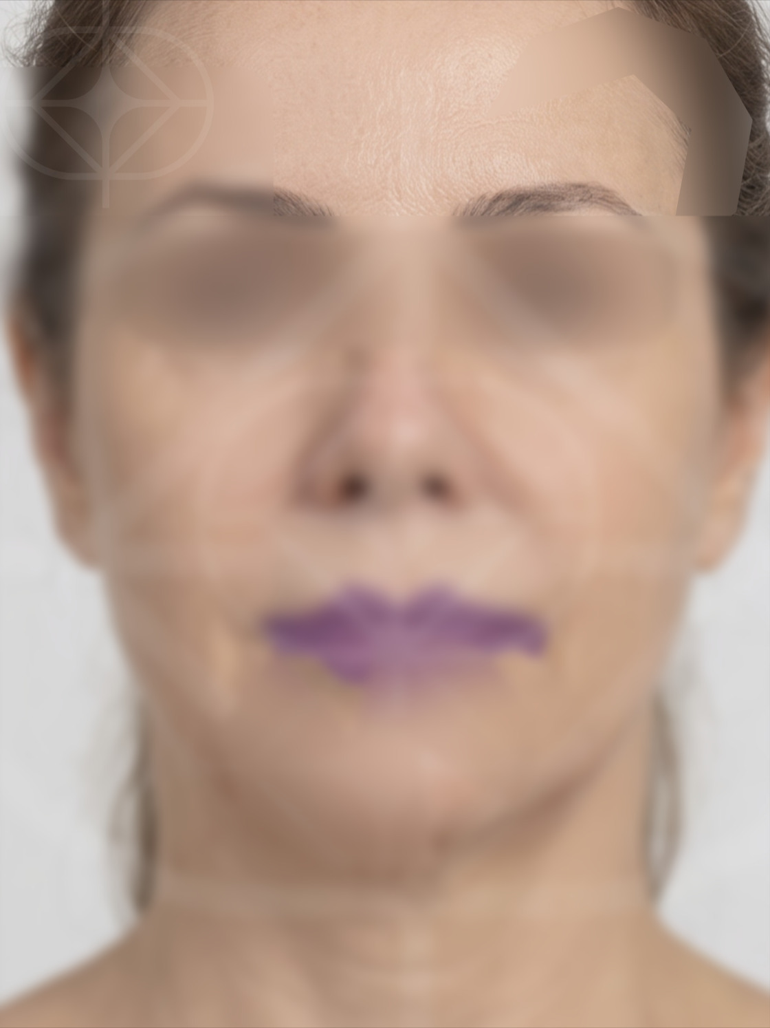 Foto antes de Torsoplastia realizado por Dr. Jose Fernando