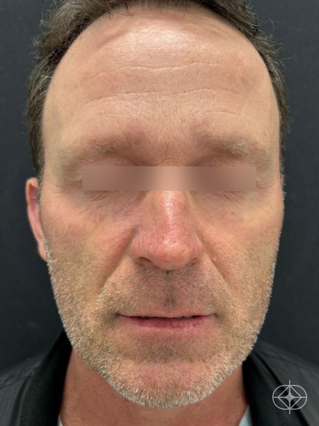 Resultado após Preenchimento com Ácido Hialurônico realizado por Dr. Guilherme Cruz