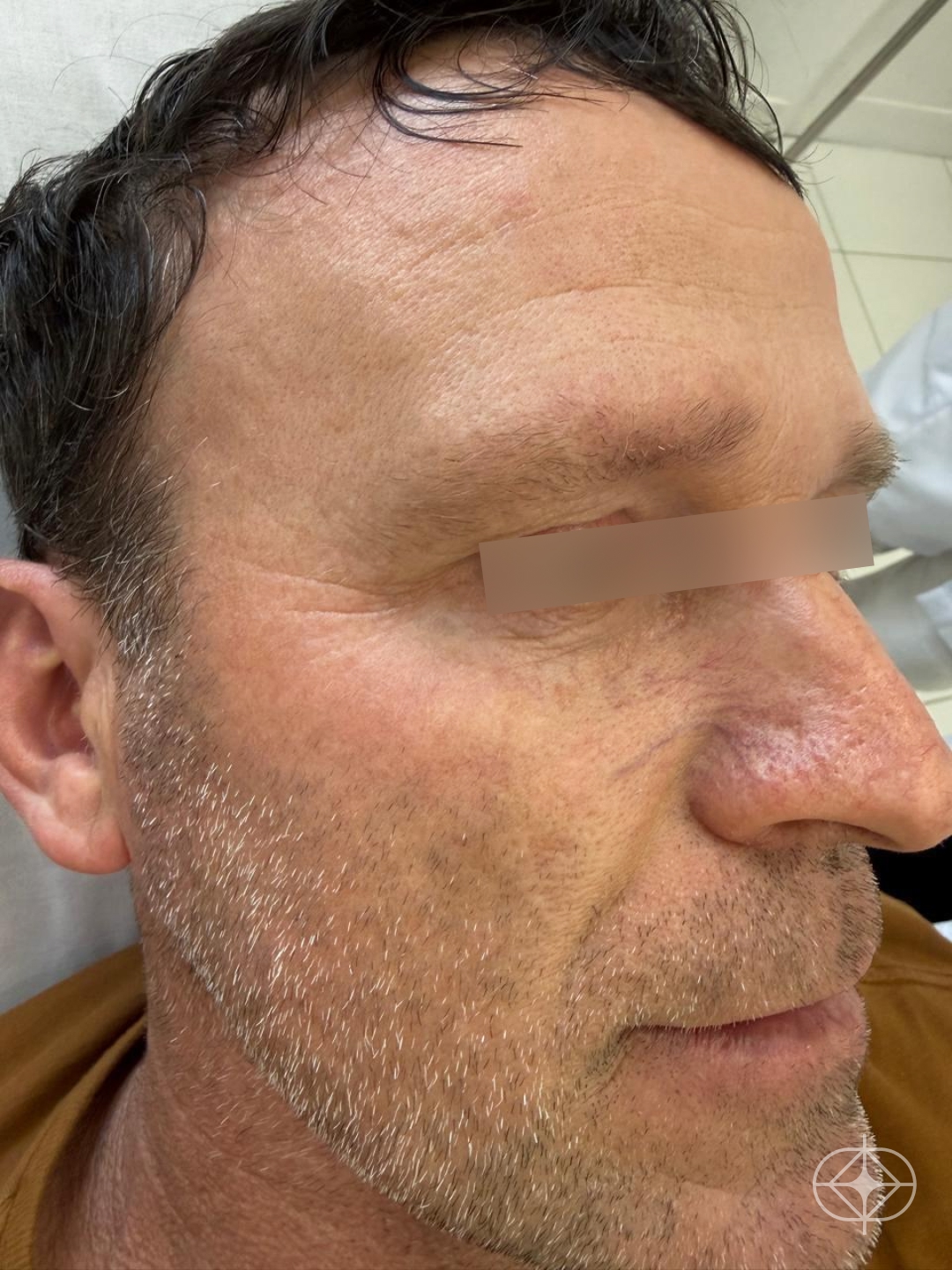 Foto antes de Preenchimento com Ácido Hialurônico realizado por Dr. Guilherme Cruz