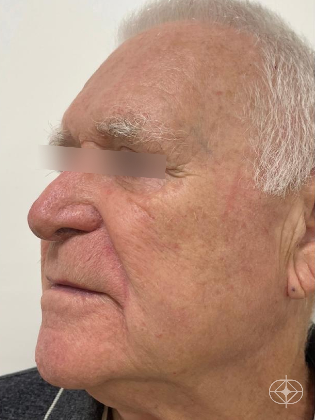 Resultado após Preenchimento com Ácido Hialurônico realizado por Dr. Guilherme Cruz