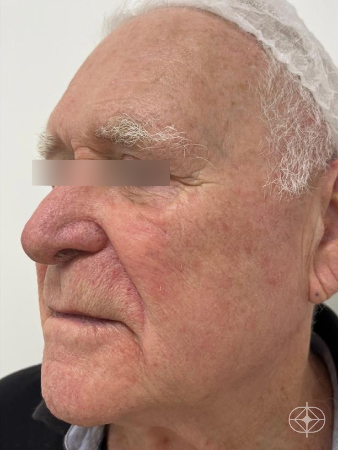Foto antes de Preenchimento com Ácido Hialurônico realizado por Dr. Guilherme Cruz