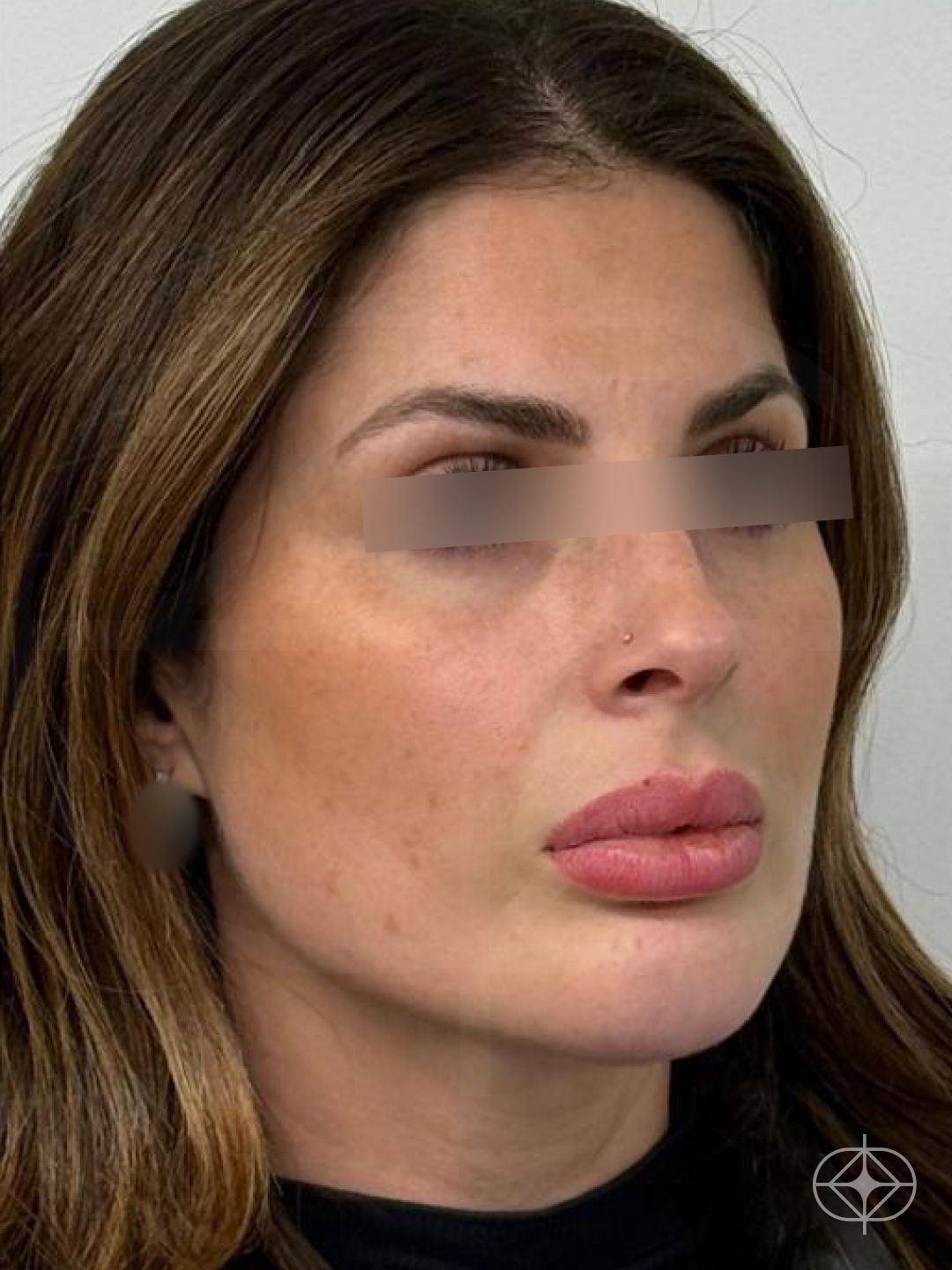 Resultado após Lifting Facial (Ritidoplastia) realizado por Dr. Jose Fernando