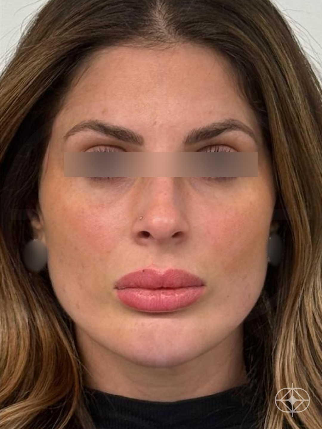 Lifting Facial (Ritidoplastia) - Pós