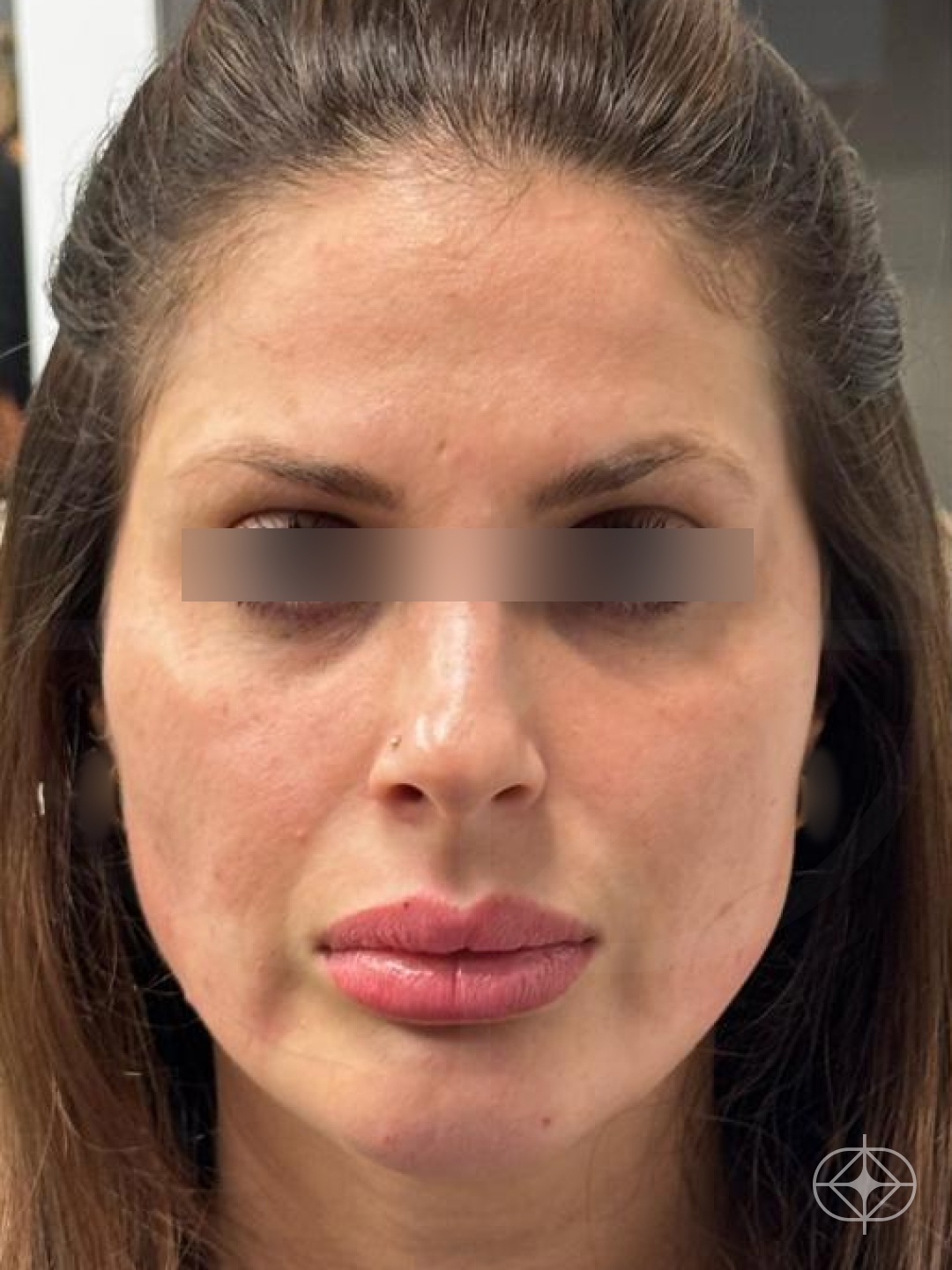 Lifting Facial (Ritidoplastia) - Pré