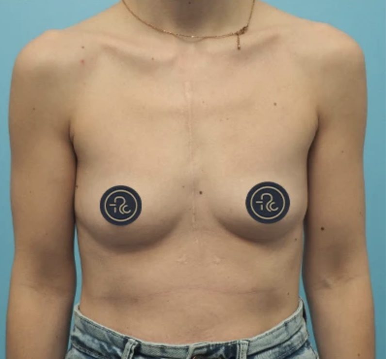 Foto antes de Mamoplastia de Aumento realizado por Dr. Fábio Vieira