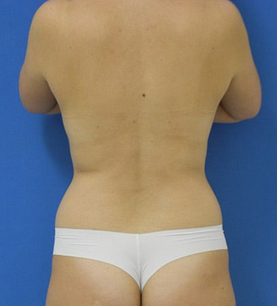 Foto antes de Lifting Facial (Ritidoplastia) realizado por Dr. José Fernando
