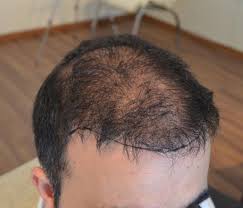 Resultado insatisfatório de Transplante Capilar