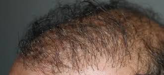 Resultado insatisfatório de Transplante Capilar