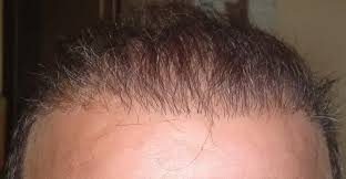 Resultado insatisfatório de Transplante Capilar